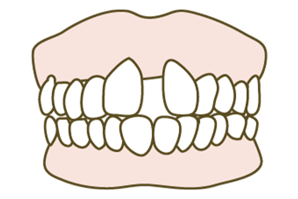 すきっ歯の矯正にかかる費用や期間について